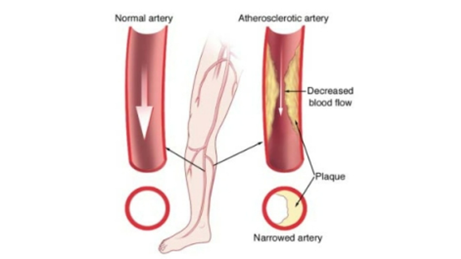 Penyakit Arteri Perifer
